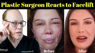 Plastic Surgeon Reacts  Lorry Hills Facelift Before amp After [upl. by Kcirrej]