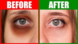 Fix the Root Cause of Dark Circles Under the Eyes [upl. by Yelnoc]