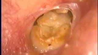 中耳炎 珍珠瘤 right COM RO cholesteatoma neartotal perforation of ear drum [upl. by Millburn]