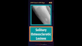 Causes of Solitary Osteosclerosis lesions Radiology tutorials  1000 cases in 100 days  video 12 [upl. by Reider]