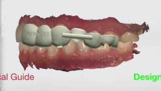 Digital Implant Dentistry A Patient Treatment Demonstration [upl. by Healey]