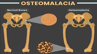 OSTEOMALACIA [upl. by Nirtak144]