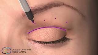 CO2 Laser Upper Blepharoplasty Animation [upl. by Calva790]