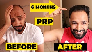 ✅ PRP 6 MONTH RESULTS  3 PRP sessions  HAIR TRANSPLANT vs PRP which one should you really go for [upl. by Dippold]