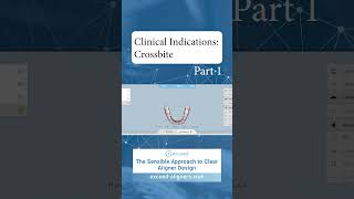 Clinical Indications Crossbite Part 1 [upl. by Grail]