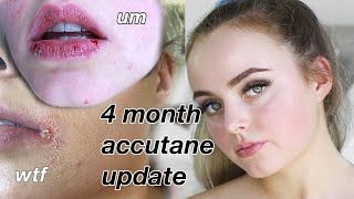 4 MONTH ACCUTANE UPDATE  HORRIBLE SIDE EFFECTS  Conagh Kathleen [upl. by Wieren]