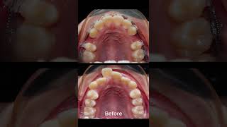 Braces proces  tooth extraction fix overbite teeth [upl. by Jerz25]