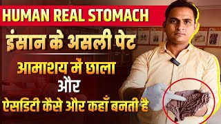 FullVideoAcidity amp Gastric Ulcer in Real Stomach  इंसान के असली पेट में ऐसिडिटी और छाले viral [upl. by Nannette]