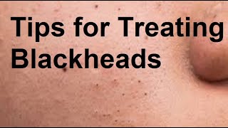 Tips for Treating Blackheads [upl. by Annovy]