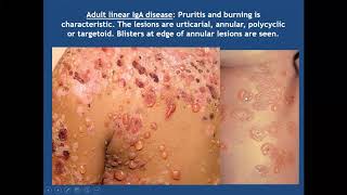 Lecture 49 Bullous Pemphigoid and related diseases PartII Rooks chapter 50 [upl. by Naibaf]