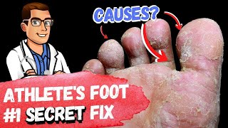 BEST Athletes Foot Fungus Treatments HOME Remedies  3 BIG SECRETS [upl. by Roseline]