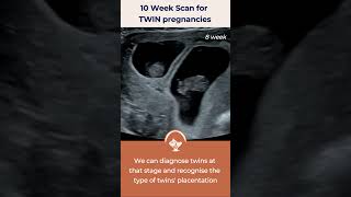 10 Week Scan for Twins [upl. by Adirf]