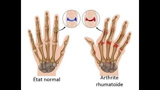 L’arthrite rhumatoïde  comment en contrôler les symptômes [upl. by Tori]