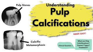 Pulp Calcifications  What is it  Types Treatment  Endodontics [upl. by Anela]