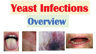 Candidal Yeast Infections Overview  Oral Thrush Vaginal Intertrigo Esophageal Candidiasis [upl. by Marelya]