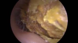 244  16 cm Measured LUMP of Solid Ear Wax Removed using Microsuction  Mr Neel Raithatha THC [upl. by Eniluap]