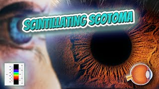 Scintillating scotoma Your EYEBALLS 👁️👁️💉😳💊🔊💯✅ [upl. by Casavant]