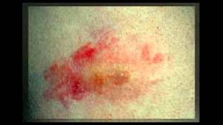 Stages Of Shingles Rash [upl. by Aro]