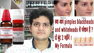 Homeopathic medicine for acne  Pimples  Blackheads  Whiteheads  My formula [upl. by Ramsey]