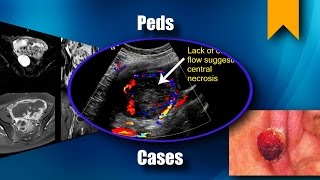 Ovarian NonGestational Choriocarcinoma [upl. by Atram]