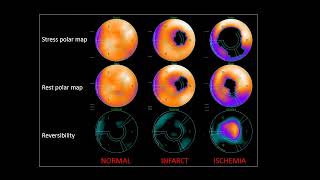 Nucradsharewordpresscom HOW TO READ MYOCARDIAL PERFUSION SCAN [upl. by Airemat]