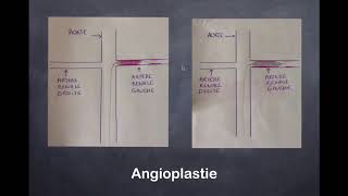 Sténose de lartère rénale  2 Radiologie Interventionnelle [upl. by Neenahs295]