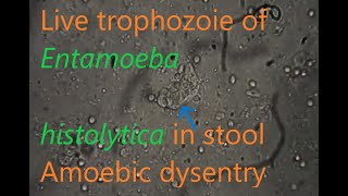 Entamoeba histolytica trophozoite in stool [upl. by Nyrrek]