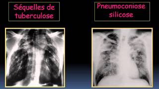 RADIOLOGIE ATELECTASIE Lobaire et segmentaire 2 [upl. by Nas]