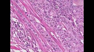 Histopathology Urinary bladderTransitional cell carcinoma [upl. by Airdnaid]