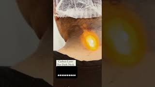 Carbon laser treatment dark neck whitening in processskincarebeautylaserbeautysmoothskinWhiting [upl. by Flavio]