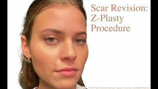 Scar Revision ZPlasty Procedure [upl. by Orteip371]