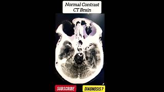 Normal Contrast CT Brain  Radiology [upl. by Retnuh62]