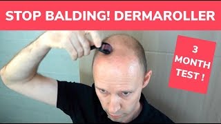 How to Use a Derma Roller for Acne Scars  Micro Needling  Before amp After  Madams Choice [upl. by Iviv161]