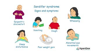 Sandifer syndrome [upl. by Eedrahc]