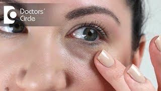 Causes of long lasting red splotcheses under the eyes  Dr Rasya Dixit [upl. by Isma]