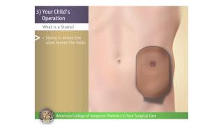 Pediatric ColostomyIleostomy Your Childs Operation [upl. by Silvestro]