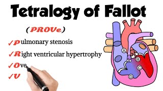 Tetralogy Of Fallot [upl. by Augustina728]