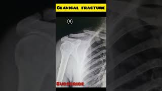 Displaced Clavical Fracture X ray Right Shoulder fluidsim shortvideo science fea what viral [upl. by Ahseyk]