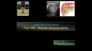 Ultrasound Case 105  Ileocolic Intussusception [upl. by Waverly]