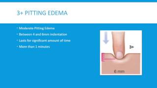 Pitting Edema Grading Scale 4 Levels [upl. by Iralav305]