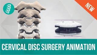 Cervical Spine Disc Arthroplasty  Latest Joint Replacement Surgery in the Neck [upl. by Anerac]