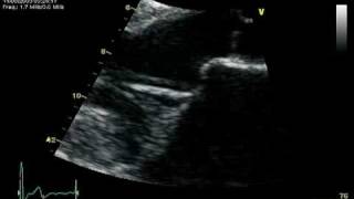 1 PROLAPSE MITRAL VALVE PARASTERNAL LONG AXIS [upl. by Erbua]