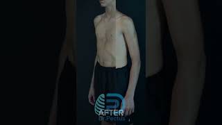 Pectus Excavatum Vacuum Bell Treatment  Dr Pectud Clinic [upl. by Driskill]