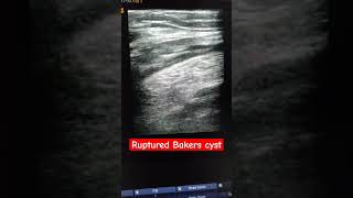 Ruptured bakers cyst with leakage of fluid btw fascia plane of semimembranosus and gastrocnemius [upl. by Yauqram776]