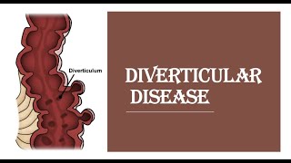 Diverticular diseasediverticulitis  pathogenesis clinical feature investigation management [upl. by Shiroma]