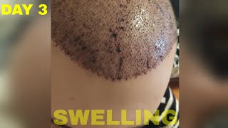 Hair Transplant Results DAY 3 FUE Turkey [upl. by Soren]