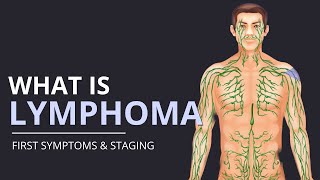 What is Lymphoma First SYMPTOMS and How Its STAGED  The Patient Story [upl. by Jobe989]