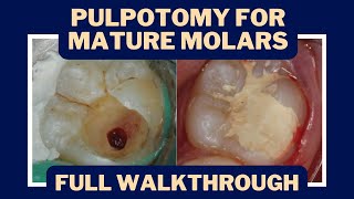 Pulpotomies for Irreversible Pulpitis The Rise of Vital Pulp Therapy  PDP133 [upl. by Konrad]