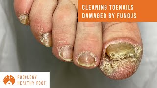 Smooth Toenail Cleaning for Patient Comfort and Before Onychomycosis Treatment Toenail Fungus [upl. by Klump859]