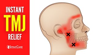 How to Relieve TMJ Pain at Home  30 SECOND RELIEF [upl. by O'Connor]